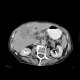 Hepatocellular carcinoma - 3 phase CT scans: CT - Computed tomography